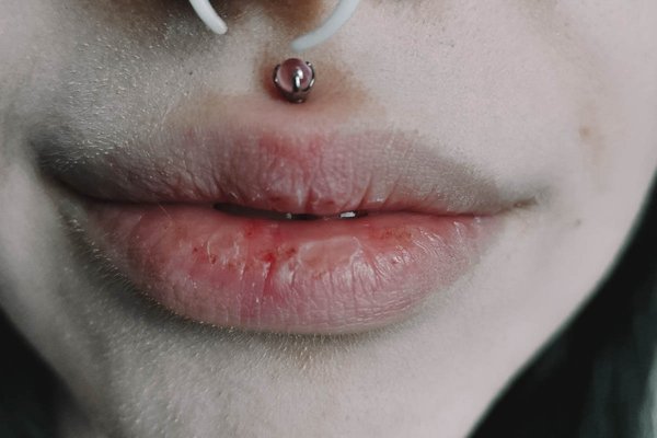 Medusa piercing
