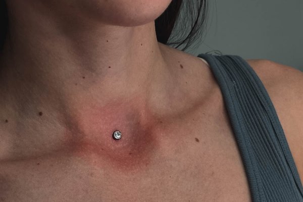 dermal piercing