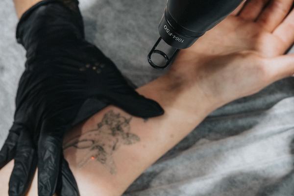 Laseri tätoveeringute ja permanendi valgendamise kursus Pärnus