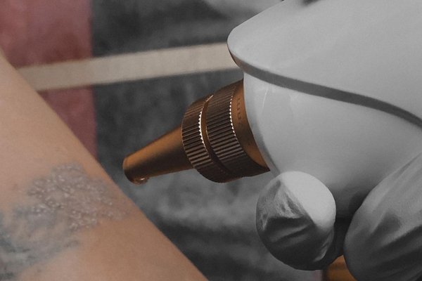 Tattoo lasereemaldus Tallinnas