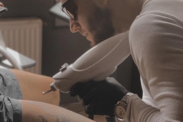 Tattoo lasereemaldus Tallinnas