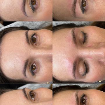 tattoo lightening with laser before and after procedure