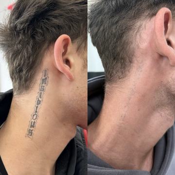 tattoo lightening with laser before and after procedure