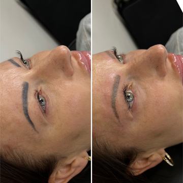 tattoo lightening with laser before and after procedure