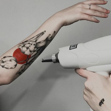 Tattoo lasereemaldus Tallinnas